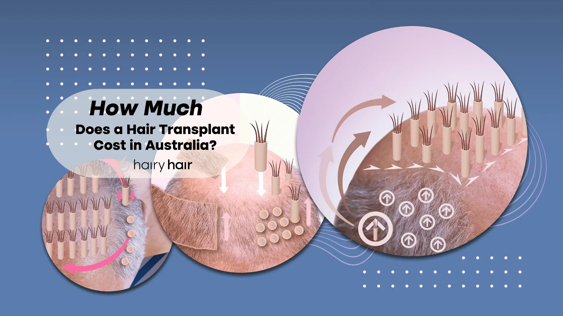How Much Does a Hair Transplant Cost in Australia?