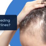 How To Treat Receding Hairlines