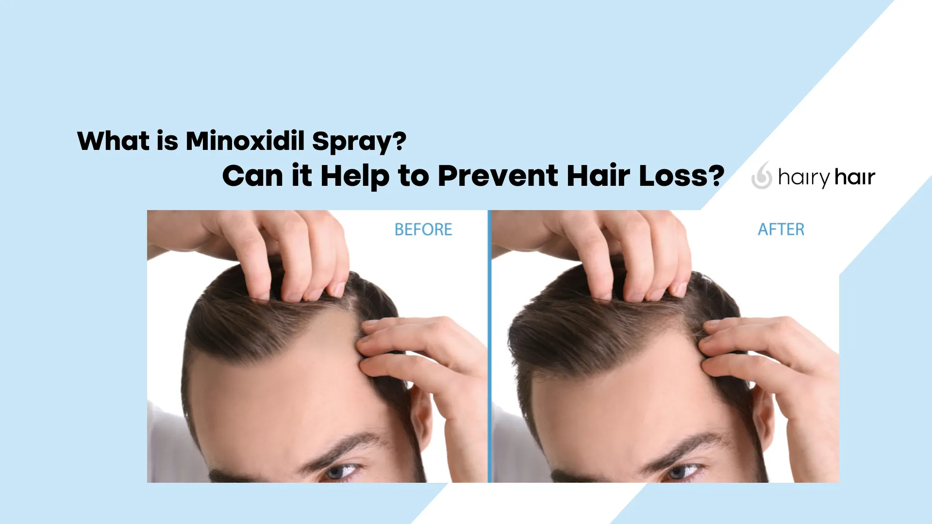 What is Minoxidil Spray? Can it Help to Prevent Hair Loss?
