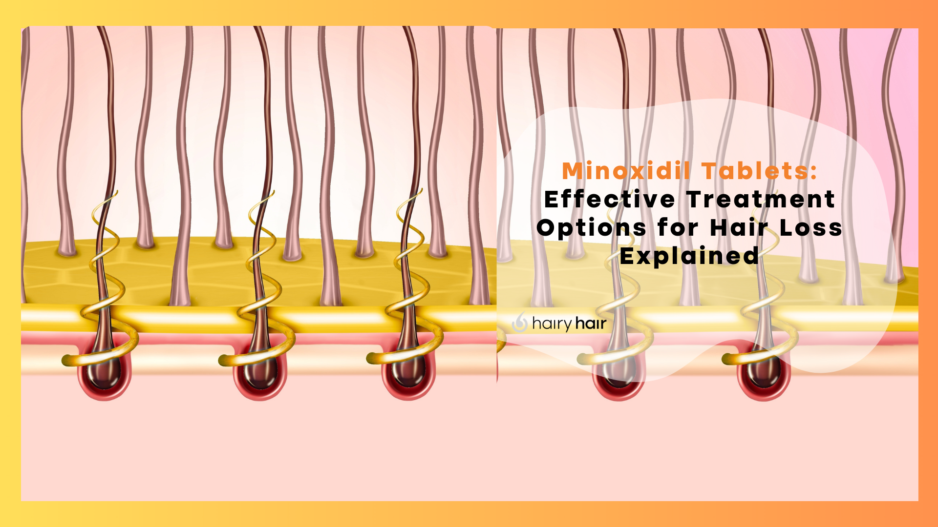 Minoxidil Tablets: Effective Treatment Options for Hair Loss Explained
