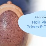 What is the Price of Hair Plugs and What Are The Options?